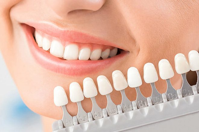 How Veneers Can Influence Jaw Alignment and Reduce Tension Headaches