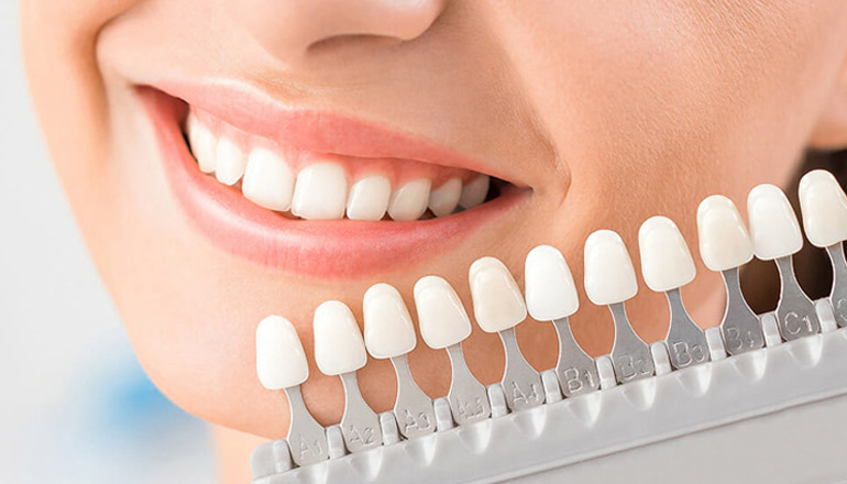 How Veneers Can Influence Jaw Alignment and Reduce Tension Headaches